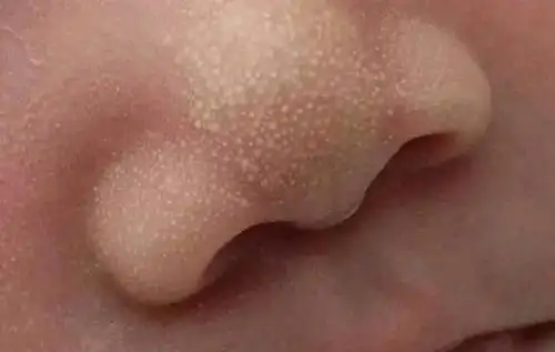 03 新生儿粟粒疹