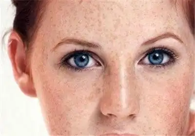 色斑_上饶皮肤病专科医院_上饶专业皮肤病医院_上饶地区最专业的皮肤