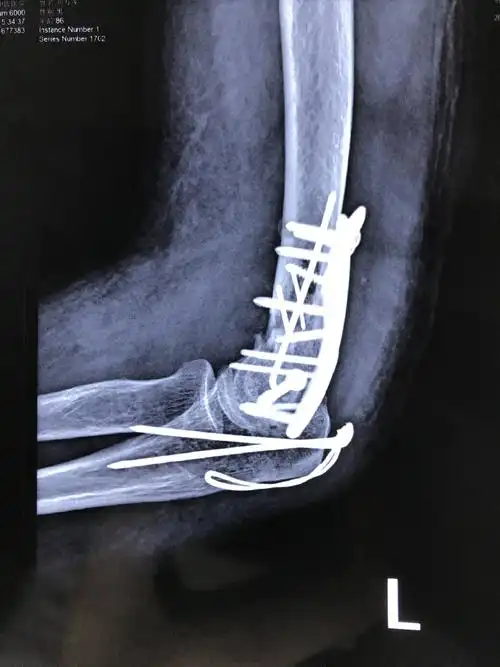 老年肱骨髁间粉碎性骨折 (原创)