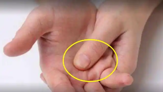 胃癌早期不疼不痒,一旦手上出现这"标记",再拖医生也救不了你