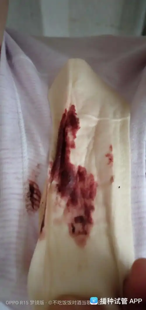 今天早上刚换的护垫,又流这么多血了,褐色变成深红色,姨妈不像姨妈