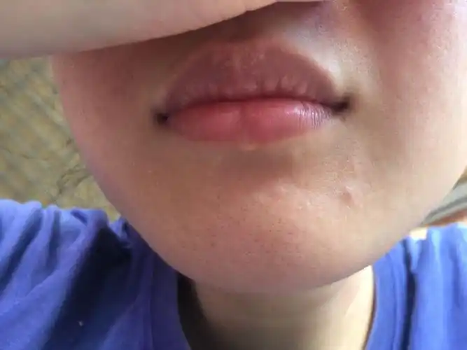 上嘴唇长白点是什么病? 女26岁 父母无遗传史,身体健康,脾胃有点虚弱.