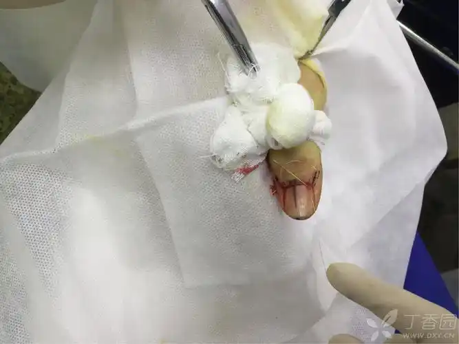 甲母痣外科手术一例 [病例帖]