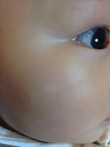 我家宝宝五个多月了,最近发现右边脸颊上方有一小块