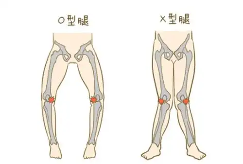 俗称"弓形腿,罗圈腿,内八字",医学专业名称为"膝内翻",畸形与膝外翻也