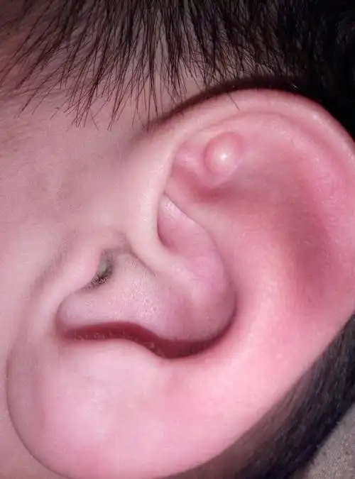 去医院问了下,医生说是个假性囊肿,如果不长就不用管,如果长就手术