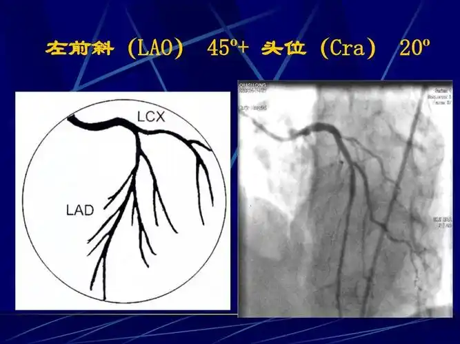 冠脉造影术简装板-绝好资料ppt