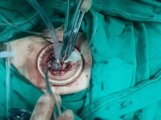 "西瓜"大的包块也能微创手术?开玩笑吧!