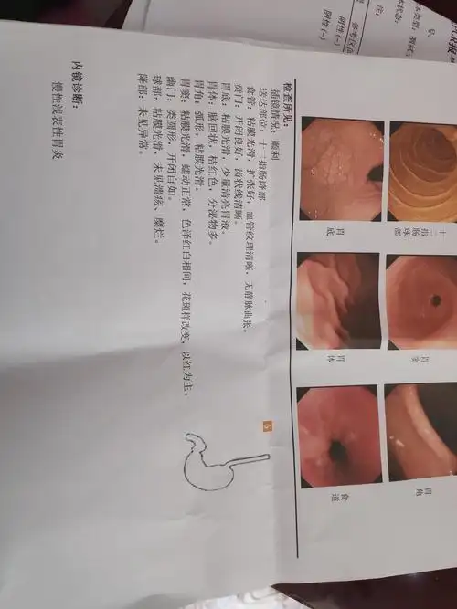 做完胃镜报告显示慢性浅表性胃炎
