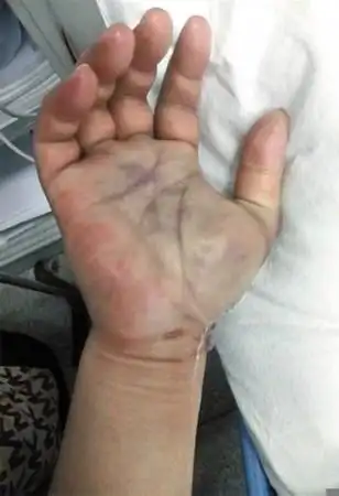 男子被鱼刺伤手 右手需截肢