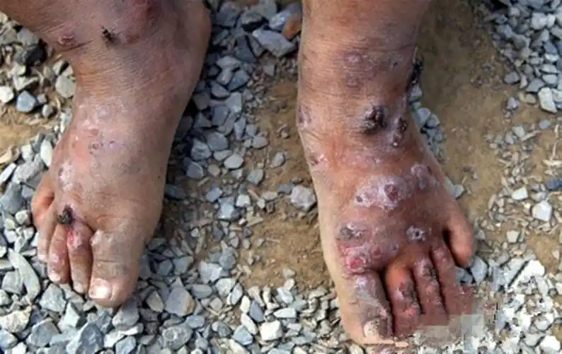 男性艾滋病晚期症状