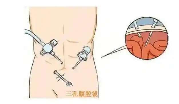 腰痛元凶竟是罕见闭孔疝,专家妙手"修补"解心忧|手术|微创|腹腔镜|肠