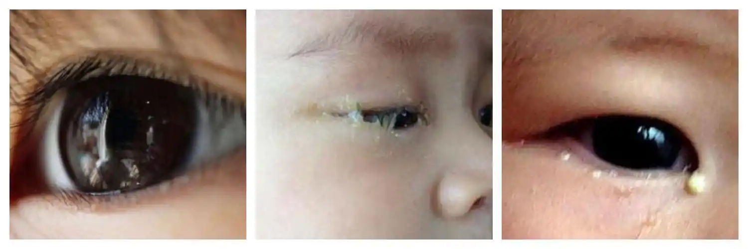 一般情况下新生儿泪囊炎发生在出生后2周内,双侧,单侧都会发生,单侧较