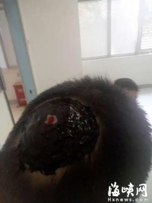 绿化树掉落蜂窝马蜂发狂追蜇 路人被扯下一块头皮