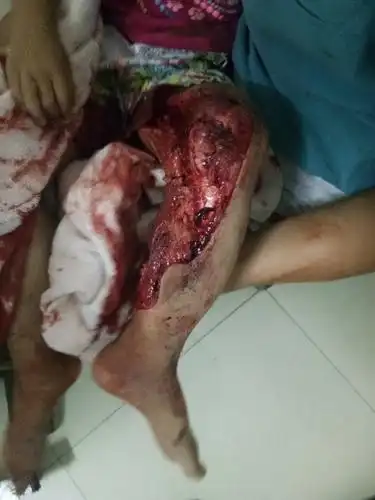 司机酒后开报废车拉货撞伤4岁小女孩 相关部门迟迟不处理