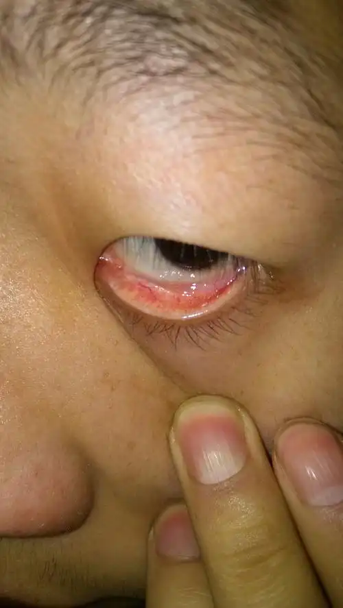 请"刘曙光"帮我看看泪阜特别红,上面还有小白点