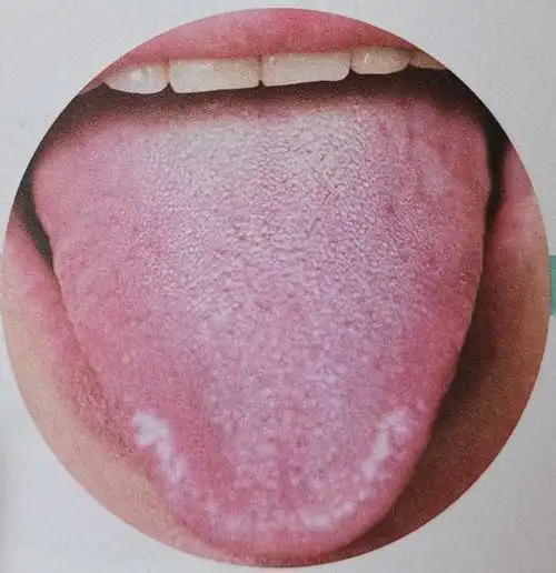 1,舌头表面有一层薄薄的白色舌苔时,表示没什么疾病,身体基本处于健康