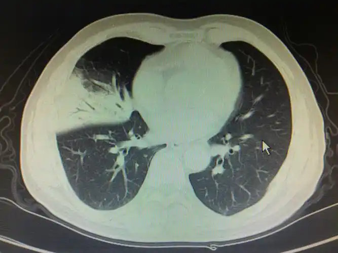 大叶性肺炎一例