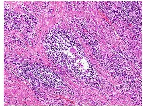 图7 微观显示炎性细胞浸润,无肿瘤细胞