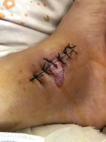 脚踝内固定拆除后第四天突然出血了,这是为什么?