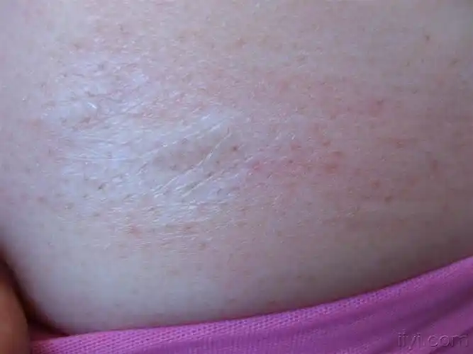 硬化性萎缩性苔藓 - 皮肤及性传播疾病讨论版 - 爱爱医医学论坛