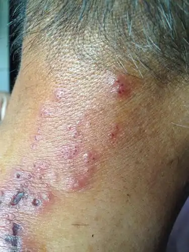 我外公脖子和胸口上都起了一些这样的痘…不知道这是什么东西