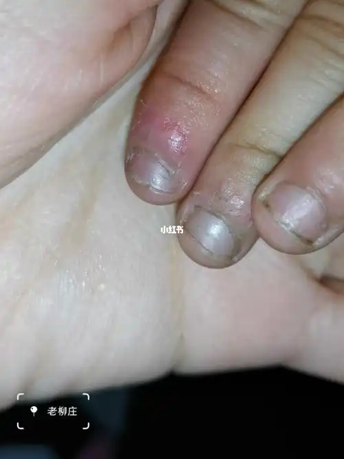 小朋友老是咬指甲怎么办