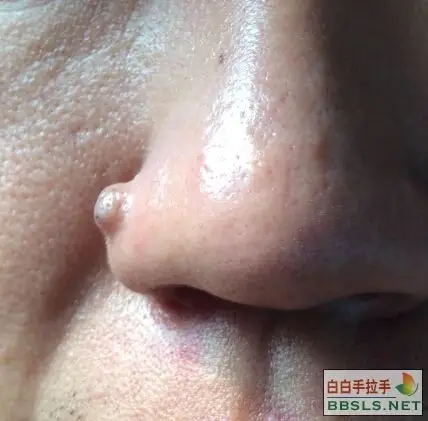 李博士您好,能帮我看一下鼻子这颗痣能去除吗?