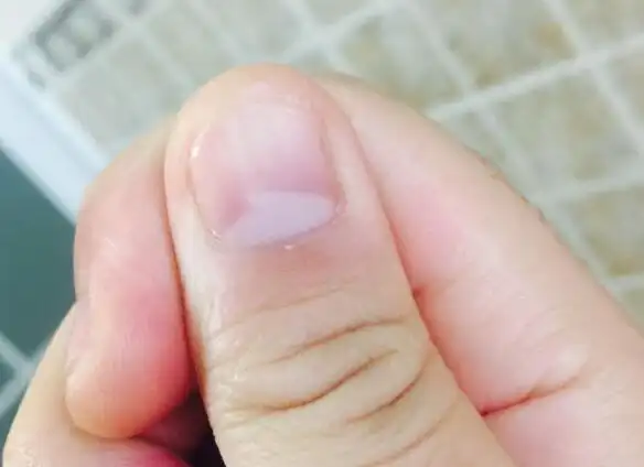只有大拇指有月牙正常吗