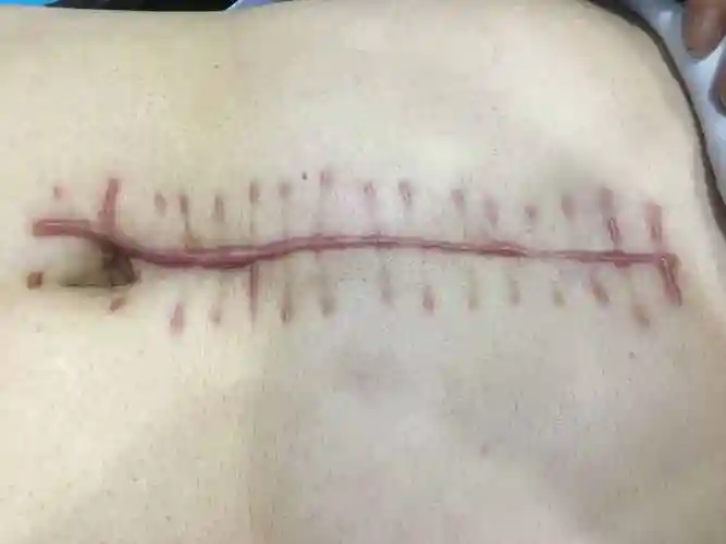 手术缝针疤痕怎么去除缝过针留下的疤痕怎么去除