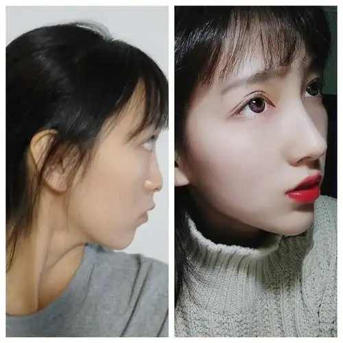 哈哈哈哈哈哈哈哈~我太爱我的鼻子了 越恢复越妈生 哈哈哈 ~每天都会