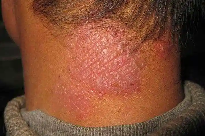 神经性皮炎症见:皮肤干燥,多角性扁平丘疹,肥厚 药用:荆芥,防风