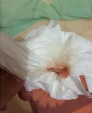 咳嗽时出现血丝痰,咳血,时间超过2周,就必须去检查,高度警惕肺癌.