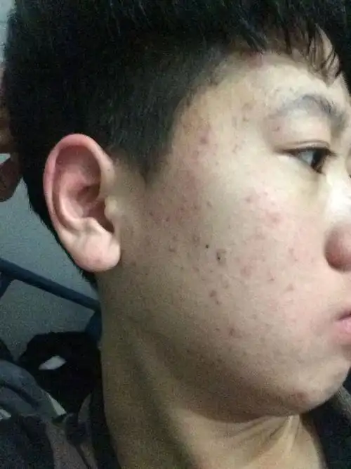 我脸上的青春痘特别多 还有特别小 红的怎么办已经快两年了 我现在15