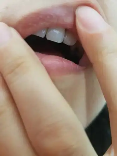 嘴唇上突然出现白点是怎么回事?很确定以前都没有今天突然发现的.如