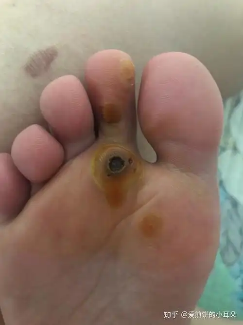 我的跖疣之路 - 知乎