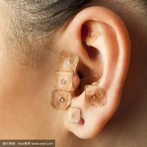 耳针疗法,人的耳朵,针灸,青少年,多代家庭