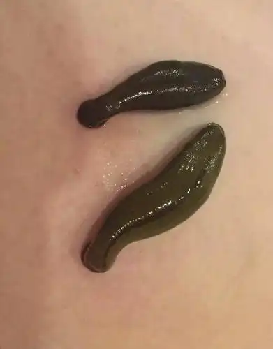 水蛭我的小医生分享——腰间盘突出-深圳慧果国际