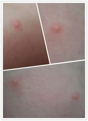 求医生,这几天全身突然长了好多红疹子,有的痒,破了的痛,有水,急