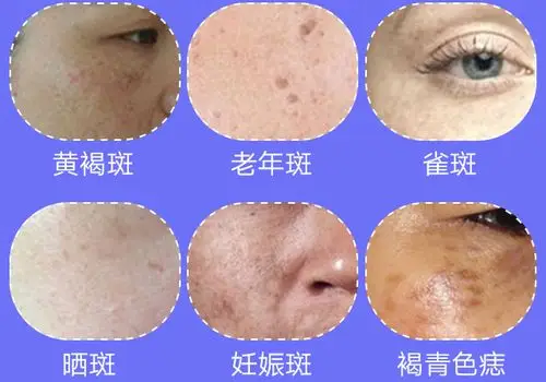 困扰您的是哪种斑点