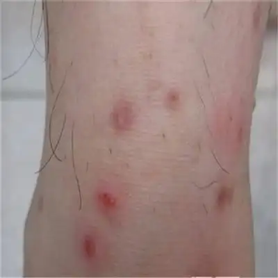 性病的早期症状图片 (56)