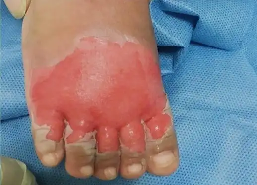 儿童意外伤害科普系列课程| 儿童烫伤