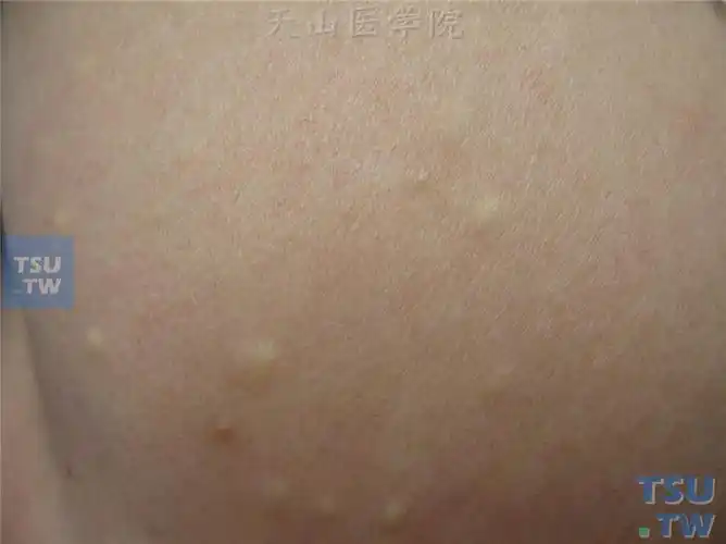 良性肿瘤:多发性脂囊瘤的症状表现