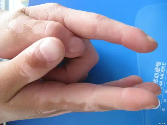 【病例讨论】7岁女孩,手部白癜风,求治疗方案 [病例帖]