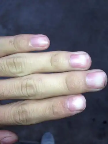 手指甲发白是怎么回事