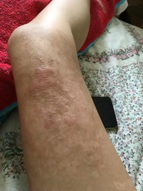 人们看到一个腿上有烫伤疤痕的女孩会怎么想呢