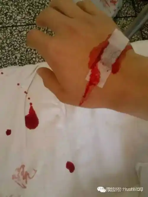 怎样扎针才不痛怎样拔针才不疼