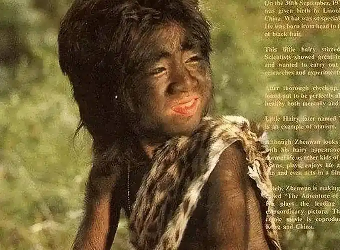 原创当年轰动一时的毛孩42岁娶90后娇妻生下一子未遗传长毛