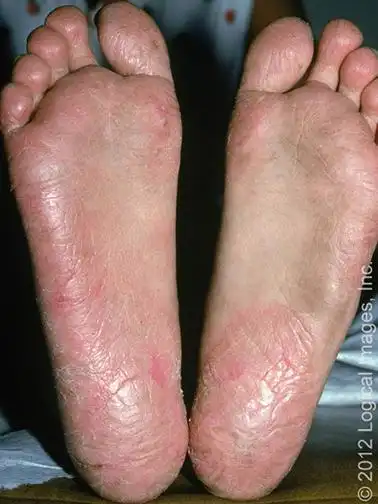 小儿接触性皮炎