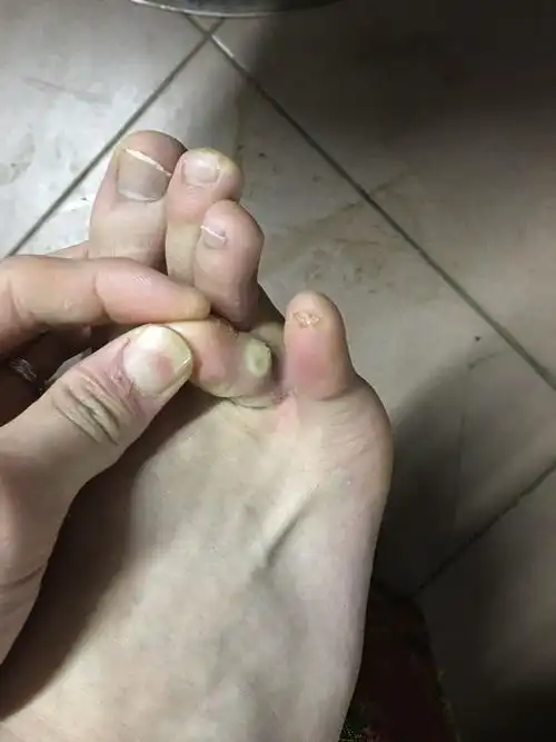 脚趾边长了个白的硬疙瘩,嗯起来很痛,长了一两天,请问这是不是鸡眼